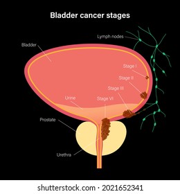 Bladder Cancer Stages Anatomical Poster Bladder Stock Vector (Royalty ...