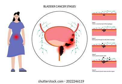 Bladder Cancer Stages Anatomical Poster Bladder Stock Vector (Royalty ...