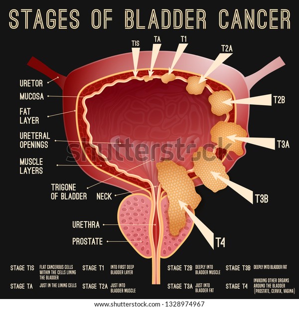 cancer prostate t2b cancer prostate t2b