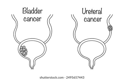 Bladder cancer and Ureteral cancer. A malignant tumor that affects the tissue of the inner wall of the bladder and the tissue of the ureter. Oncourological diseases drawn by hand. Isolated vector.