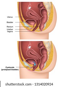 Bladder With Cystocele Medical Vector Illustration On White Background Female Body