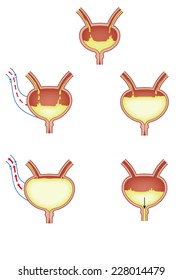 Bladder filling and nervous control of bladder as it relates to enuresis. Created in Adobe Illustrator.  Contains transparencies.  EPS 10.