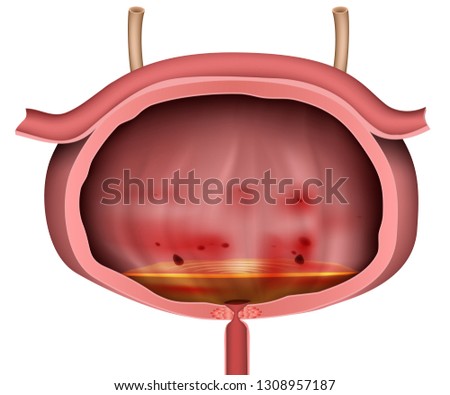 Bladder inflammation 3d vector illustration unlabeled on white background