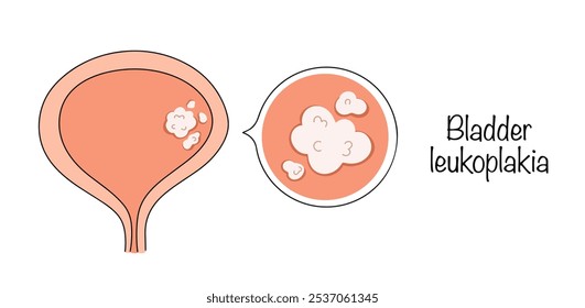 Bladder leukoplakia. A condition in which a keratinizing epithelium that is unusual for it appears on a certain area of the mucosa. Color medical illustration.