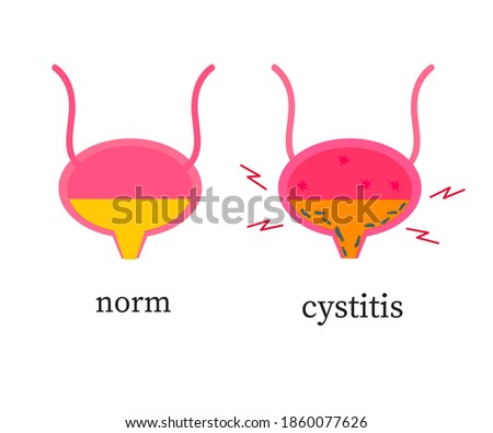 Bladder on a white background. Cystitis. Vector illustration.