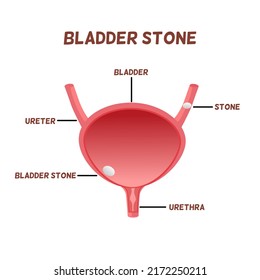 Concepto de piedra de vejiga, piedra en ureter, piedra en vejiga humana. Fondo de color de tono blanco rosado 