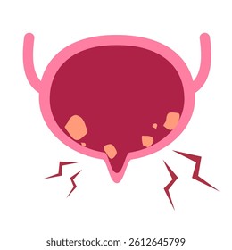 Bladder stone in urinary bladder illustration 