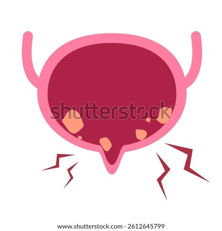 Bladder stone in urinary bladder illustration 