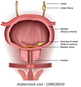 Bladder stones 3d medical vector illustration on white background