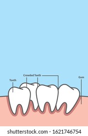 Blank banner Crowding tooth frame cartoon style for info or book illustration vector on blue background. Dental concept.