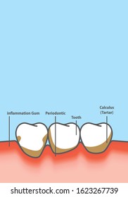 Blank banner Human gum inflammation frame cartoon style for info or book illustration vector on blue background. Dental concept.