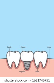 Blank banner Implant tooth between real teeth frame cartoon style for info or book illustration vector on blue background. Dental concept.