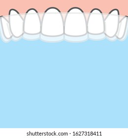 Blank banner Upper Essix retainer illustration vector on blue background. Dental concept.