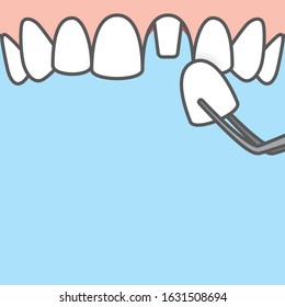 Blank banner Upper Single crown tooth illustration vector on blue background. Dental concept.