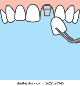 Blank banner Upper Single implant tooth illustration vector on blue background. Dental concept.