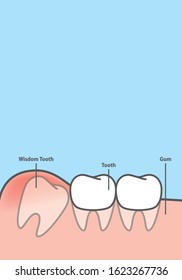 Blank banner wisdom Impacted tooth inside under inflammation gum illustration vector on blue background. Dental concept.