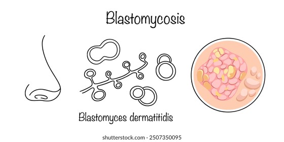 Blastomycosis. A fungal infection caused by inhalation of spores of the pathogen Blastomyces dermatitidis. Manifestation of the disease on human skin. Medical vector on white background.