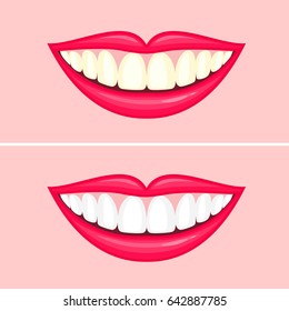 bleaching teeth treatment. Whiten teeth before and after. Vector illustration isolated on pink background. Dental care concept.