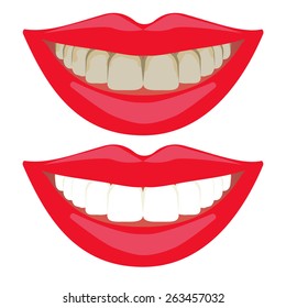 Bleaching treatment ,before and after ,woman teeth and smile, close up, isolated on white, teeth whitening comparison