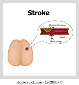 Bleeding in the brain. Insult. Stroke, atherosclerosis. Cholesterol plaques. Infographics. Vector illustration