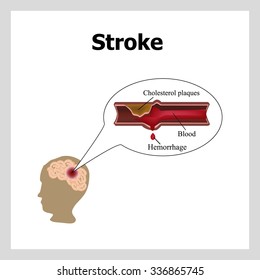 Bleeding in the brain. Insult.. Stroke, atherosclerosis. Cholesterol plaques. Infographics. Vector illustration.