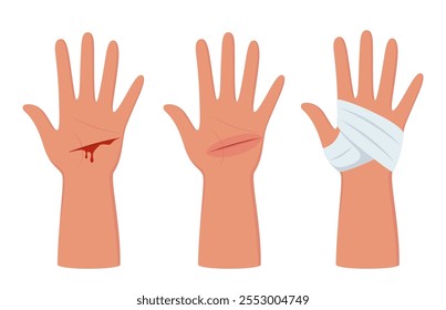 Corte de sangrado en la palma de la mano, situación de emergencia. Tratamiento de primeros auxilios para heridas en la piel. Trauma, procedimiento de tratamiento. Ilustración vectorial