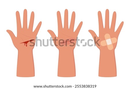 Bleeding cut on the palm, emergency situation. First aid treatment for wound on skin. Trauma, treatment procedure. Vector illustration