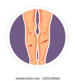 Bleeding Injury Skin Cut Or Scratch Legs Pain Isolated Vector Icon Legs Bleeding Wound Medicine And Healthcare Blood Running Stop And Treatment Trauma Infection Prevention Cover Tissue Damage