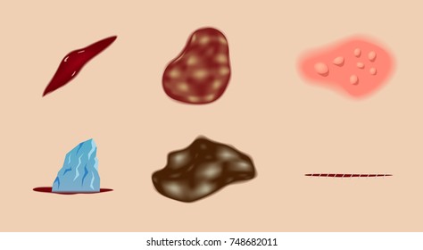 bleeding, wound on skin. A set of cuts blood and bruises , vector
