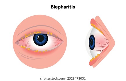 Blefarite ocular. Oftalmologia Inflamação do olho humano doente