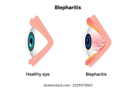 Blepharitis eye disease. Ophthalmology Inflamed sick human eye and healthy eye