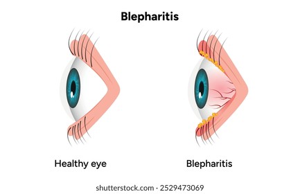 Blepharitis eye disease. Ophthalmology Inflamed sick human eye and healthy eye