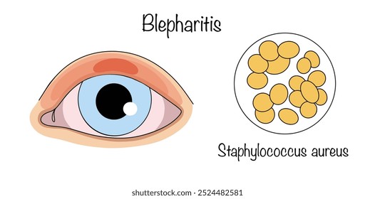 Blepharitis. Inflammatory lesions of the edges of the eyelids. A common cause of blepharitis is infection with Staphylococcus aureus. Hand drawn color medical illustration. Vector illustration.