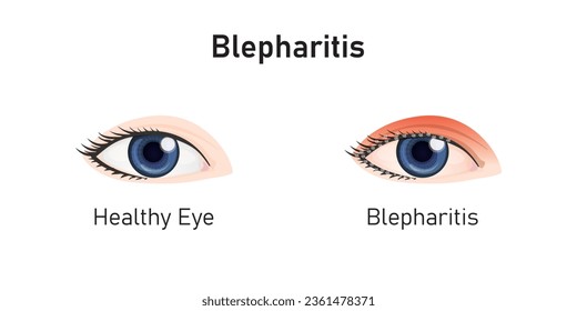 Diseño conceptual del síndrome de Blepharitis. Ilustración vectorial.