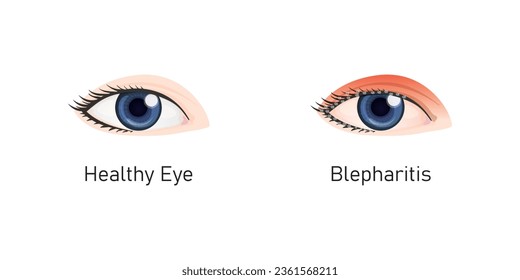 Blepharitis Syndrome Concept Design. Vector Illustration.