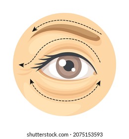 Blepharoplasty cosmetic surgery procedure of female face with dotted lines. Plastic surgery vector illustration