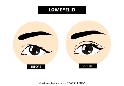 Blepharoplasty of eyelid , before and after vector illustration