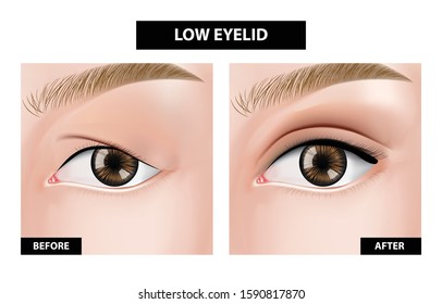 Blepharoplasty Of Eyelid , Before And After Vector Illustration