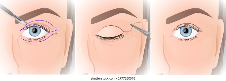 blepharoplasty procedure, plastic surgery of the upper eyelid, before and after images, marking and suture