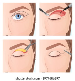 blepharoplasty procedure, plastic surgery of the upper eyelid, marking and suture, surgical incision with a scalpel