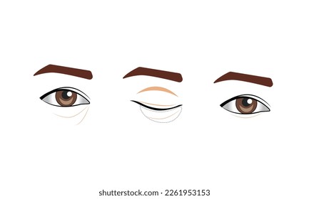 Blepharoplasty of the upper and lower eyelids
