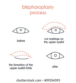 Blepharoplastische Vektorgrafik, moderne Illustration. 