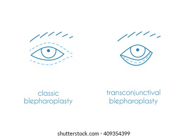 Blepharoplasty vector modern illustration. 