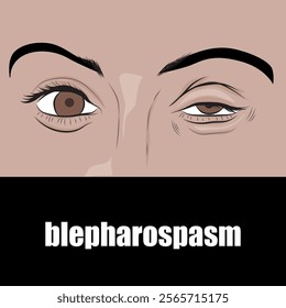 Blepharospasm is a disorder consisting of involuntary tonic contraction of the orbicularis oculi muscle and the eyebrow muscle complex.