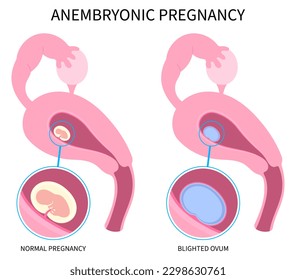 Blighted ovum of anembryonic ectopic pregnancy loss missed abortion empty egg molar conception fertilization miscarriage and early first Natural	