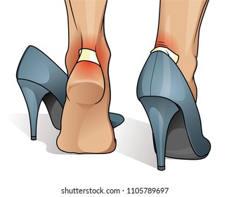 Blister and wound on woman heel