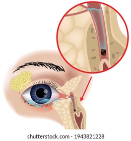 Bloqueo de los canales lácteos. Dacriocistitis. Anatomía de los ojos. La estructura de los conductos Laquimación. Cartel de entrenamiento médico. Ilustración vectorial.