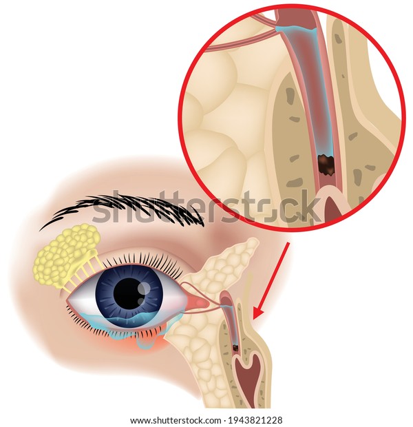 lacrimal sac inflammation