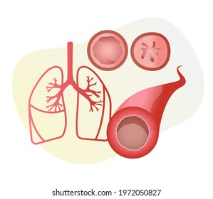 Blocked Airway In Human Lungs -  Inflamed Airway  - Illustration As EPS 10 File