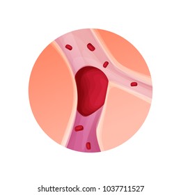 Blocked Blood Vessel - Artery With Blood Clot Realistic Vector Illustration Isolated Background